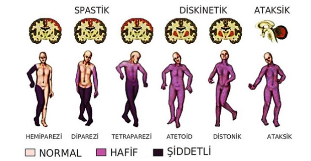 Beyin felcine evde tedavi! Serebral Palsi nedir? SP tedavisi ne kadar sürmeli?