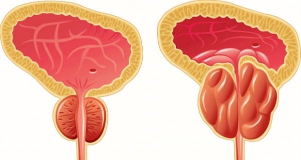 Prostat büyümesinin bu 10 belirtisine dikkat! Prostat büyümesi nedir?